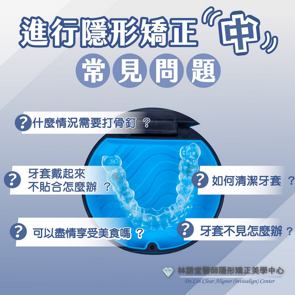 進行隱形矯正「中」常見問題