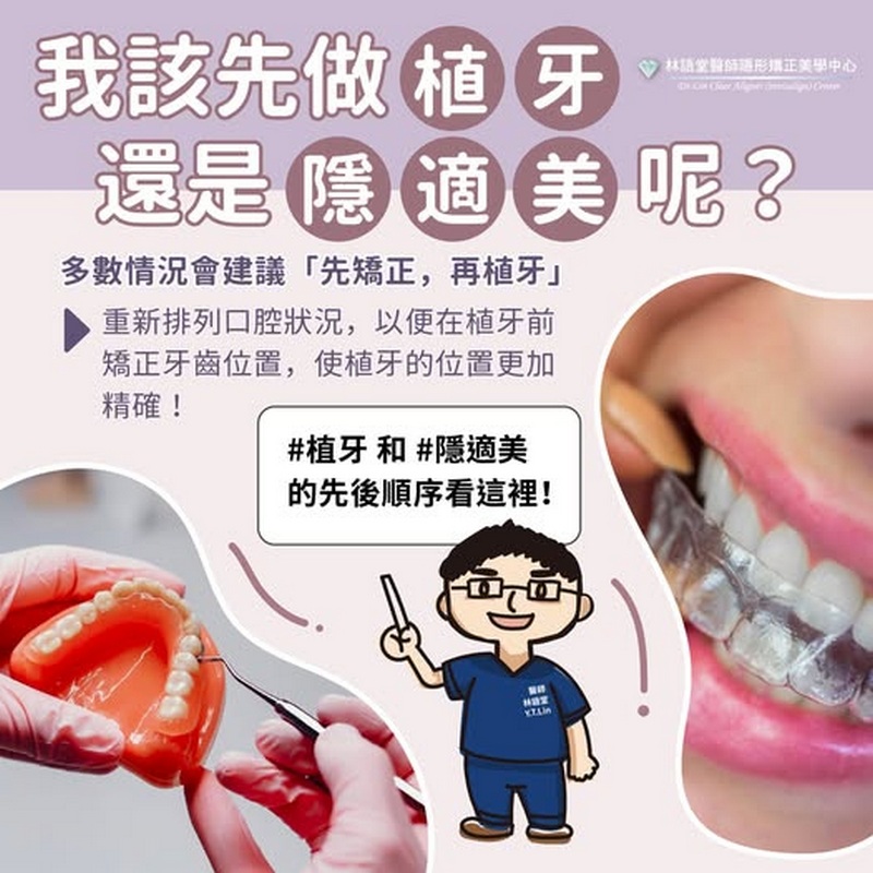 植牙後可以做隱適美嗎？