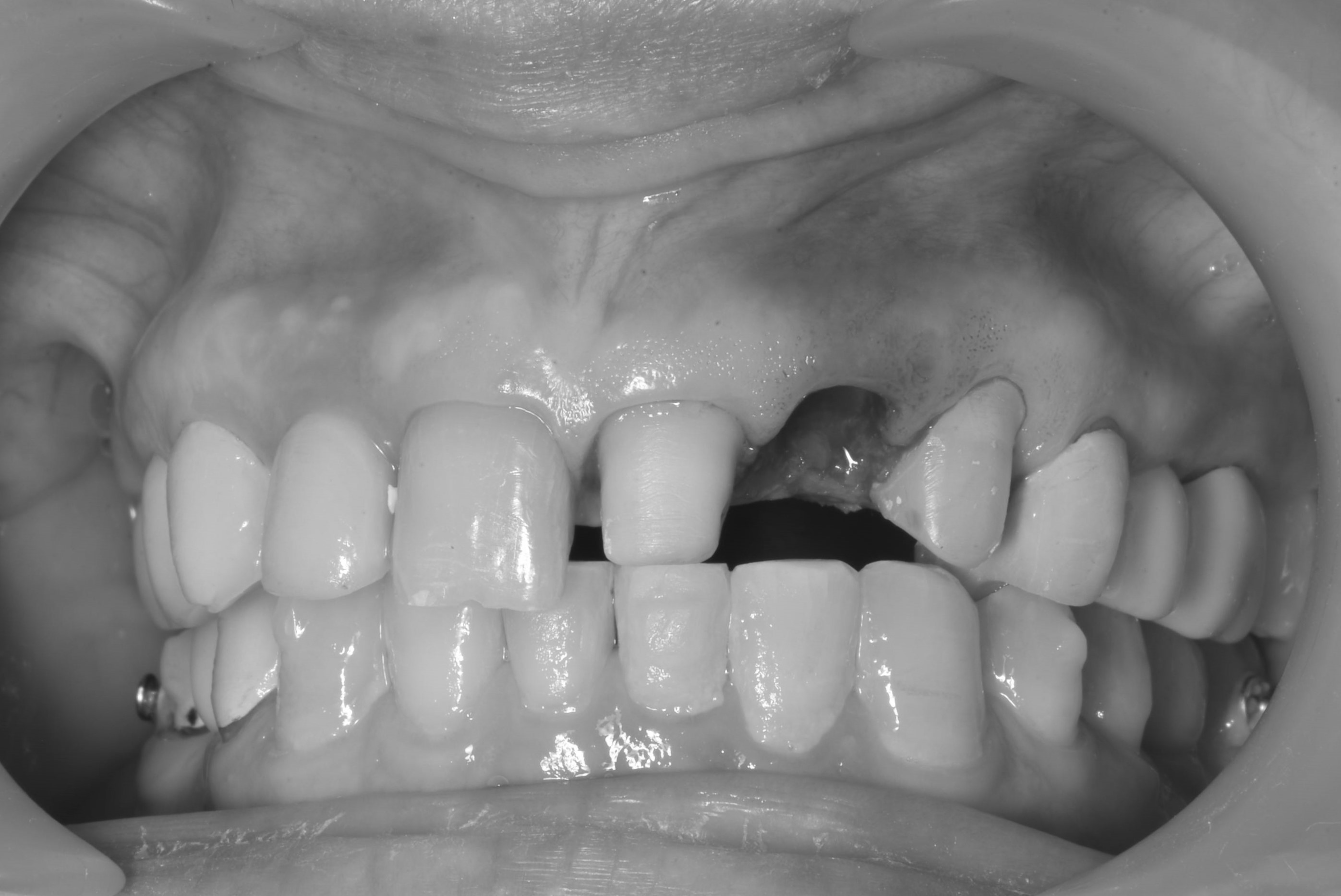 立即式植牙(即拔即種)